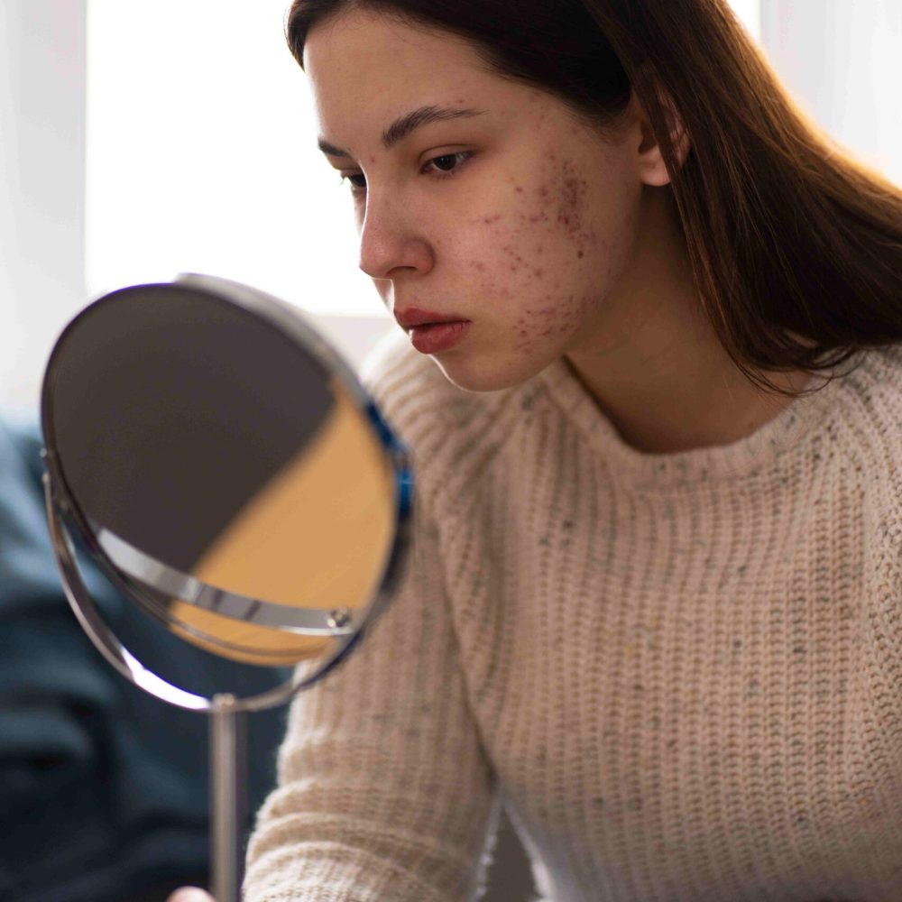 person-dealing-with-rosacea_11zon